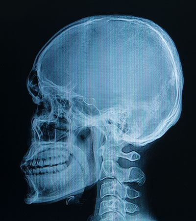 Teleradiografia del cranio