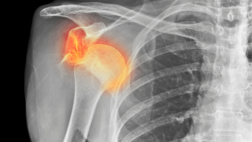 Lussazione: cosa fare, come si cura e come prevenirla