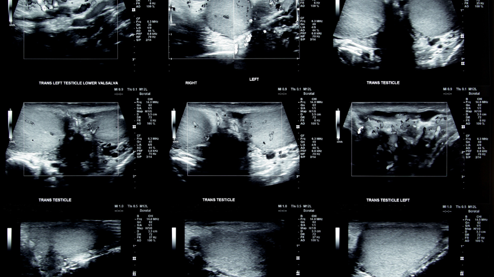 Ecografia testicolare: un controllo semplice che può fare la differenza