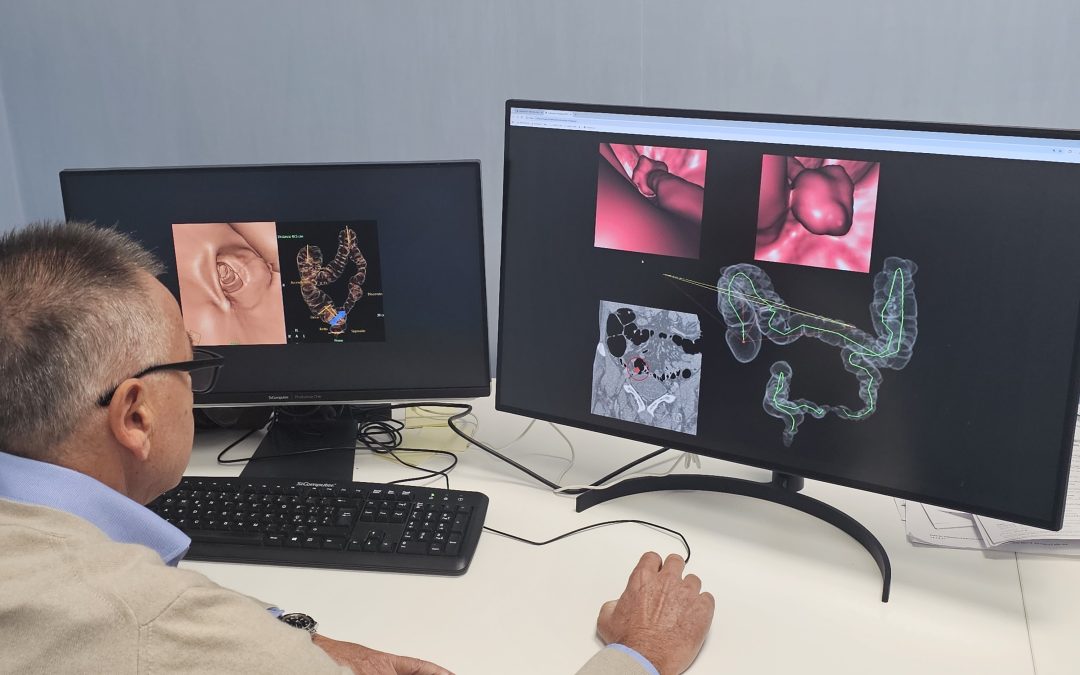 Nuova Colonscopia Virtuale 3d