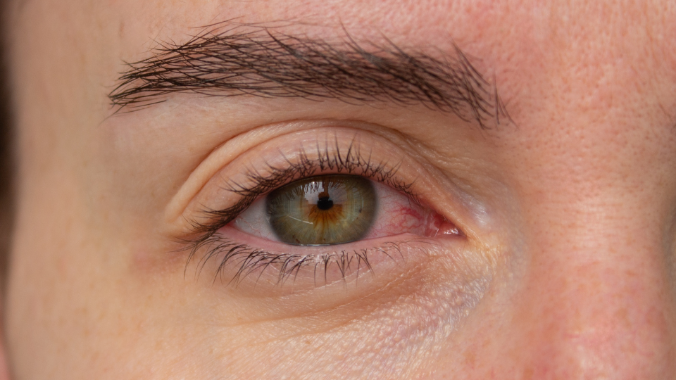 Occhi rossi e prurito: come riconoscere la congiuntivite
