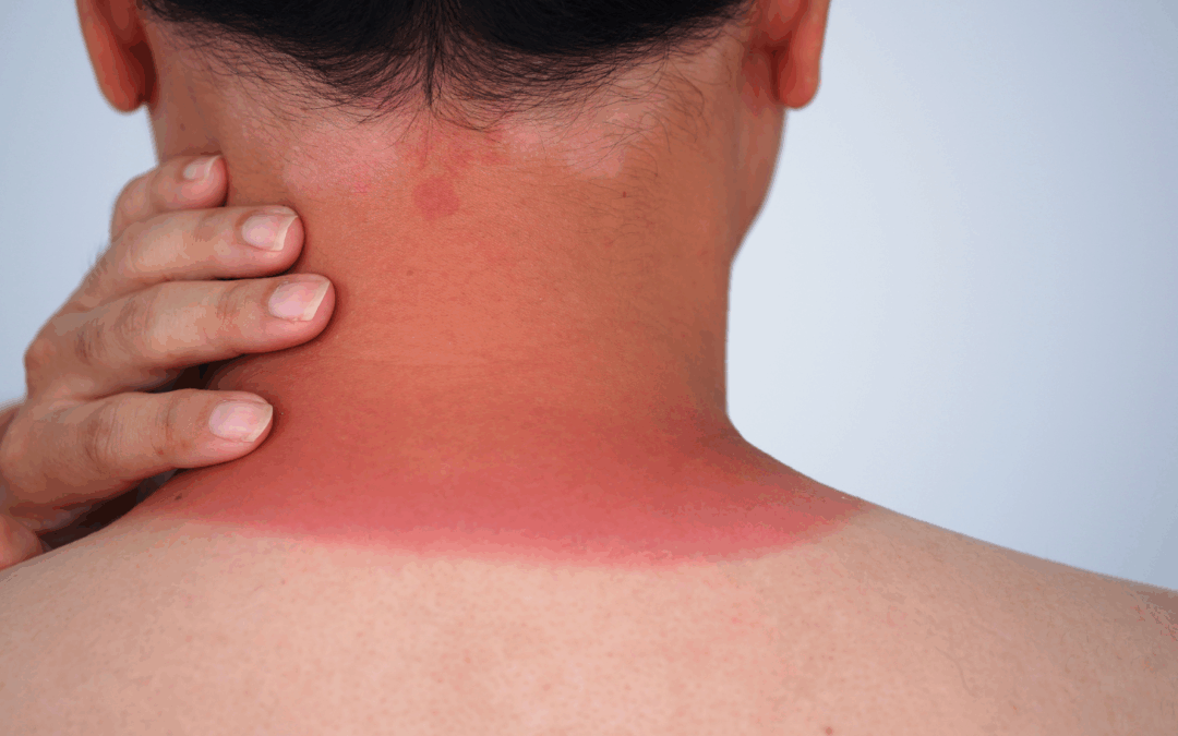 Scottature solari: errori da evitare e rimedi efficaci