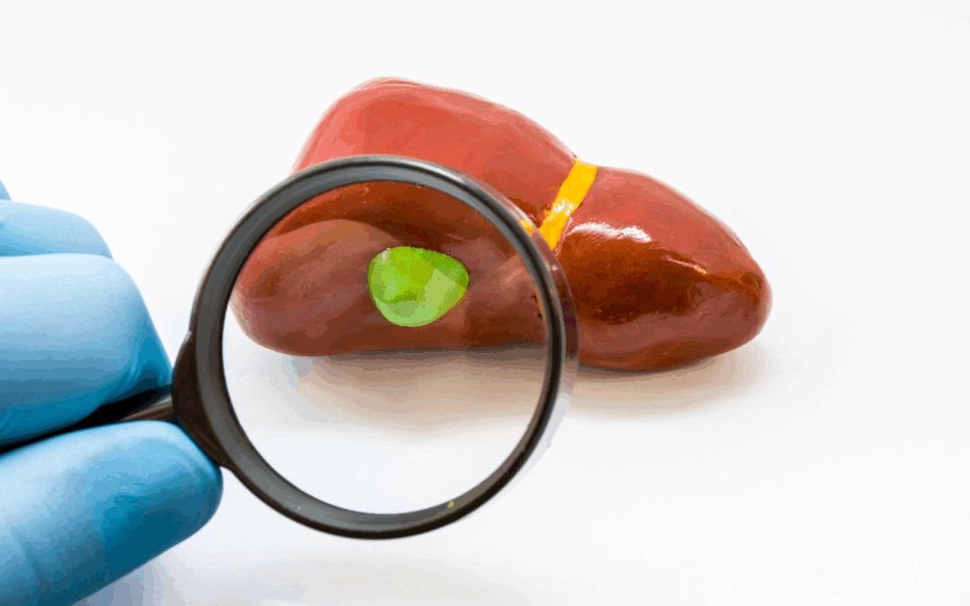 Dolore sotto le costole dopo pasti abbondanti: quando sospettare i calcoli alla colecisti