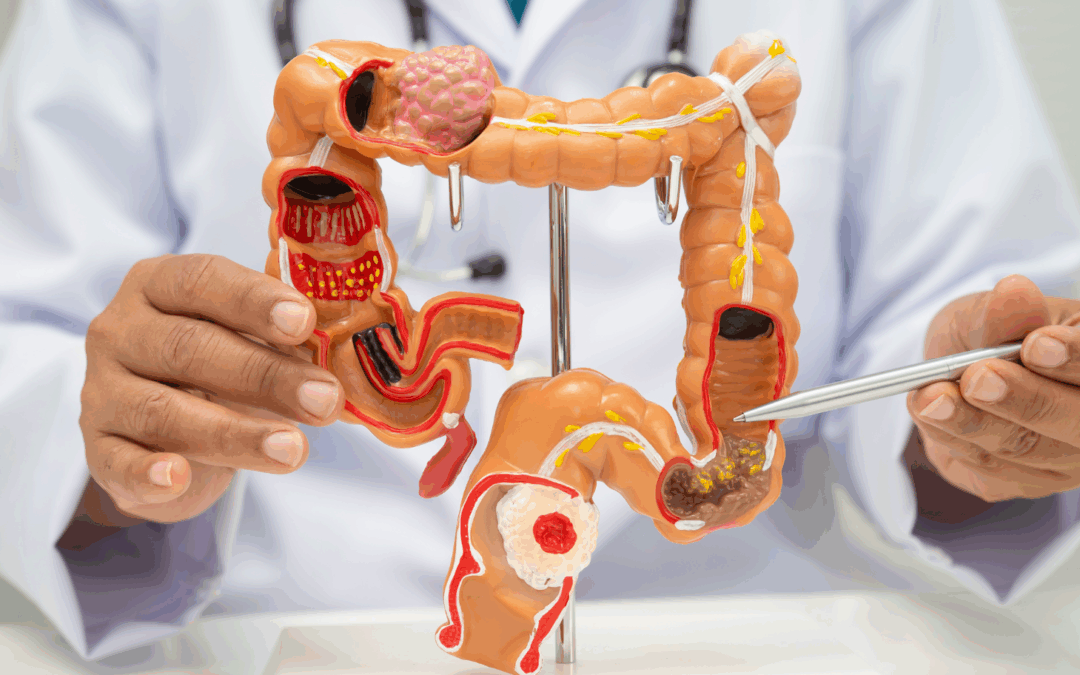 Colon irritabile al rientro: perché stress, orari e routine cambiano anche l’intestino