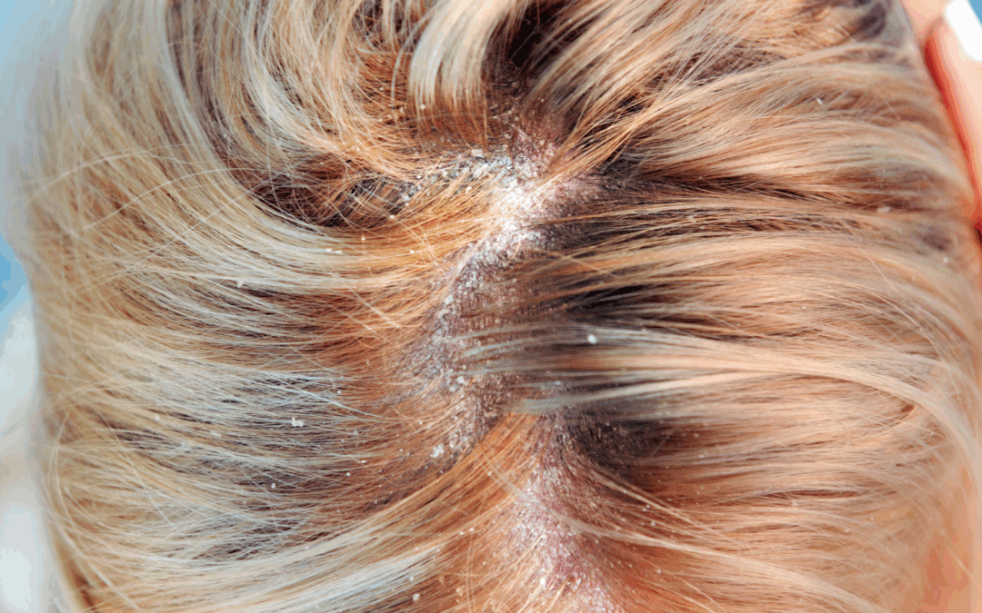 Dermatite seborroica: perché può riaccendersi con il cambio di stagione